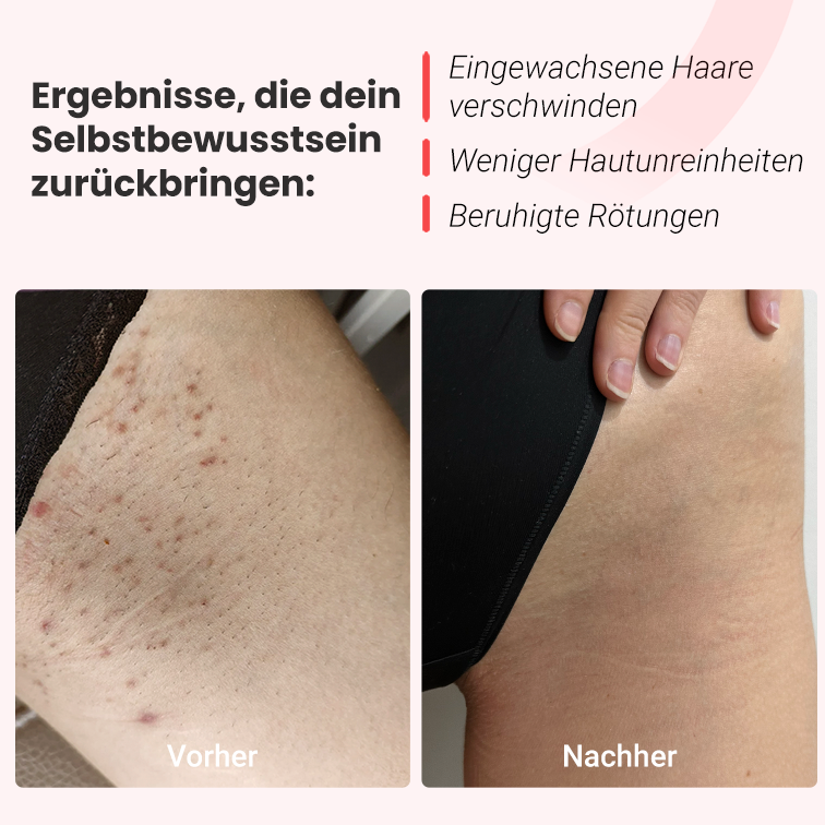 Hilda IPL-Haarentferner